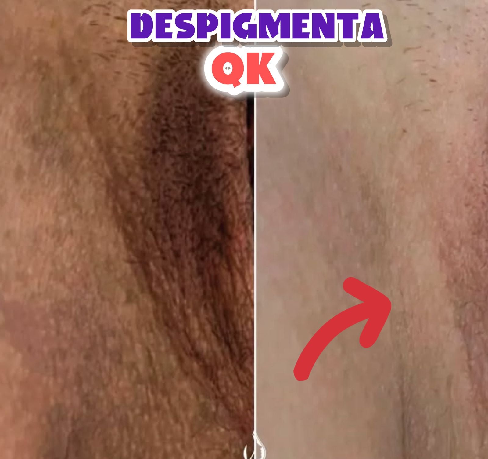 Crema especial despigmentante🎁𝗥𝗲𝘀𝘁𝗮𝘂𝗿𝗮 𝗤𝗞 & 𝗖𝘂𝗮𝗹𝗾𝘂𝗶𝗲𝗿 𝗭𝗼𝗻𝗮𝘀 𝗢𝘀𝗰𝘂𝗿𝗮𝘀